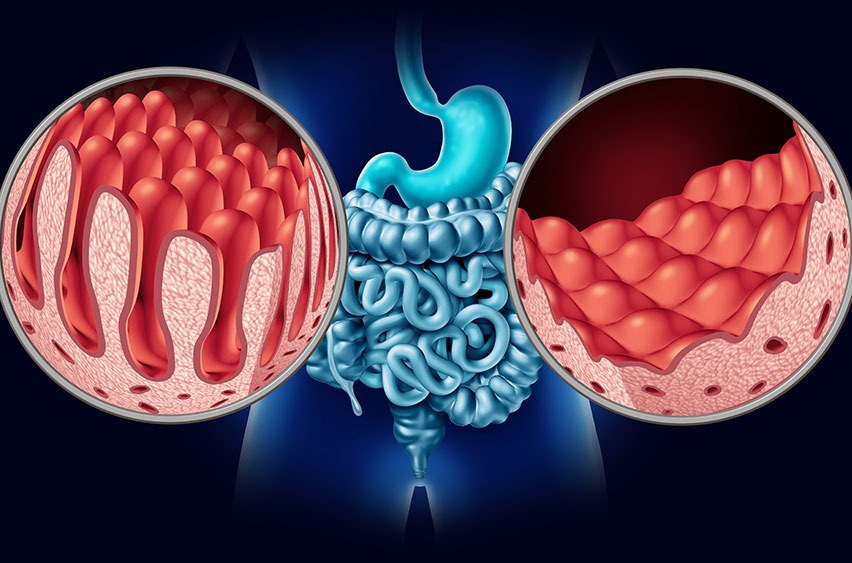 Celiac Disease | Rory Hornstein | Registered Dietitian | Calgary and Surrounding Areas